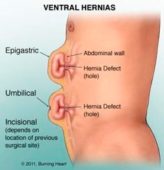 Pared abdominal