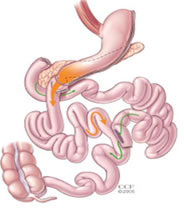 Cruce duodenal