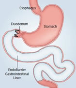 Endobarrier